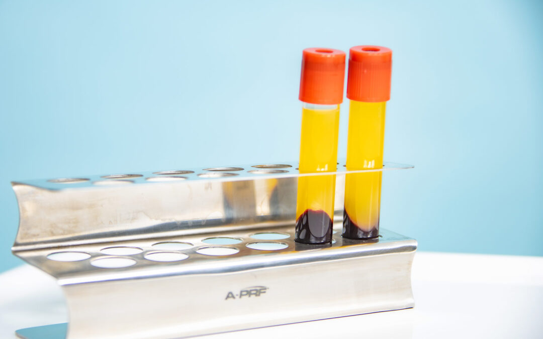Eigenbluttherapie (PRF)